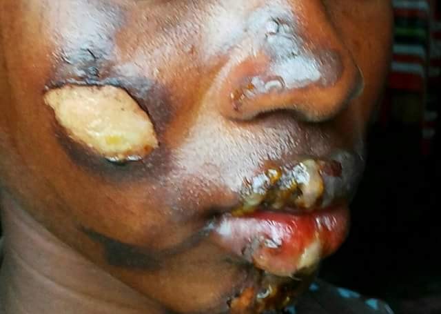 Man burns 13-year-old niece’s face and breasts with hot pressing iron over missing N3000 in Bayelsa